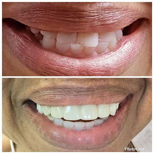 The image shows a side-by-side comparison of two individuals, one with a natural smile and the other with a cosmetic dental treatment, highlighting the difference in appearance.