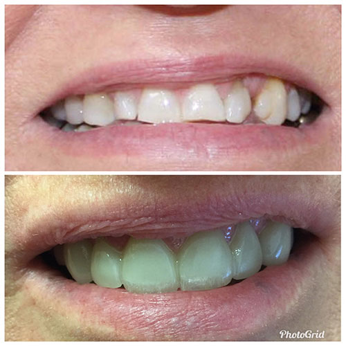 The image shows a side-by-side comparison of two individuals with different dental treatments. On the left, there is a person with a noticeable gap in their teeth, while on the right, another individual displays a full set of white teeth, which appear to be the result of cosmetic dental work.