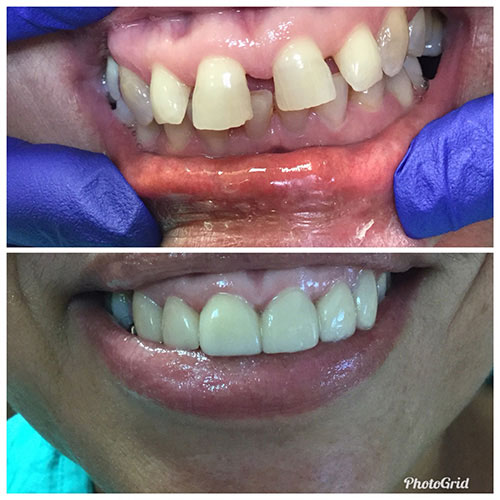 The image shows a person with a dental implant, smiling broadly at the camera.