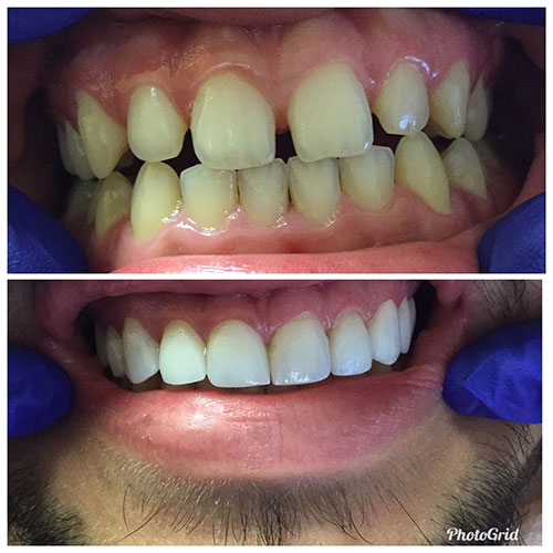 The image shows a before and after comparison of dental treatments, with the  before  side showcasing yellowed teeth and the  after  side displaying clean, white teeth.