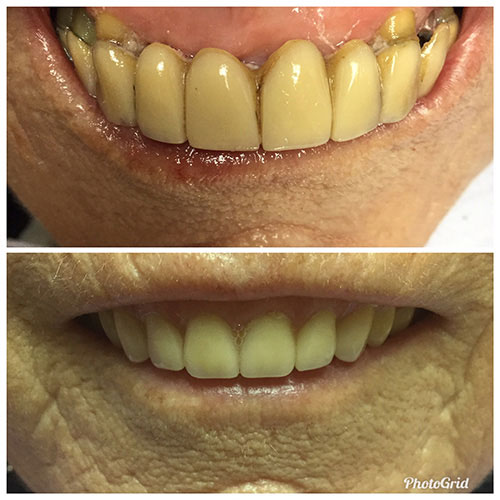 The image shows a side-by-side comparison of two different teeth whitening treatments, with the top half depicting a person s teeth after a cosmetic procedure and the bottom half showing a person s teeth before the treatment.
