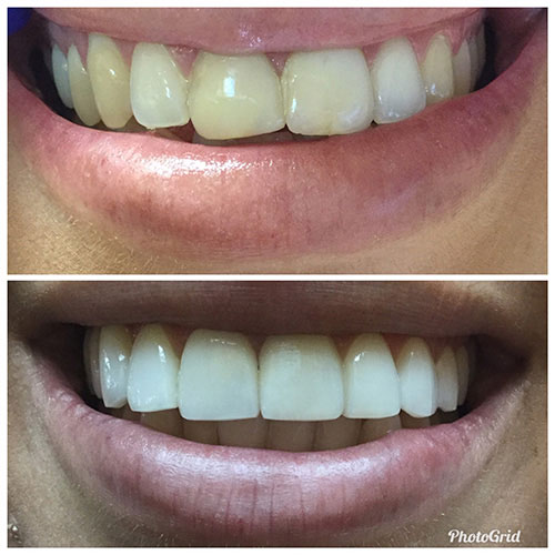 Two images of a person smiling, showcasing their teeth with a focus on dental care and cosmetic procedures.