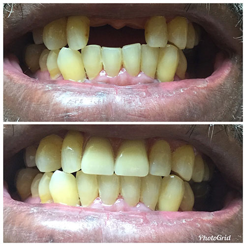 The image displays a person s mouth with severely discolored teeth, showing both upper and lower teeth with yellow stains.