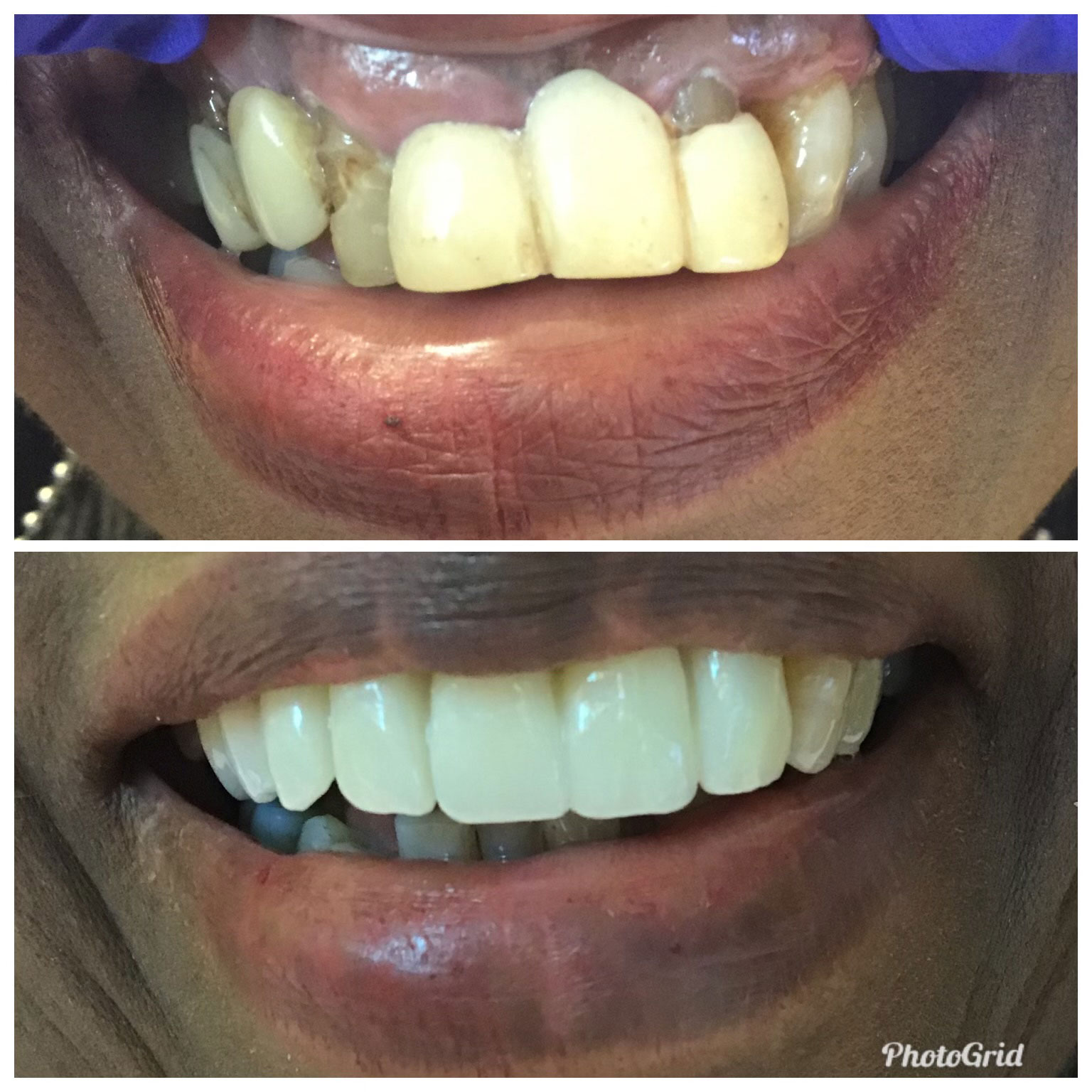 The image shows a side-by-side comparison of a person s teeth, with the left side showing discolored and possibly damaged teeth, while the right side displays brighter, cleaner teeth after dental treatment.