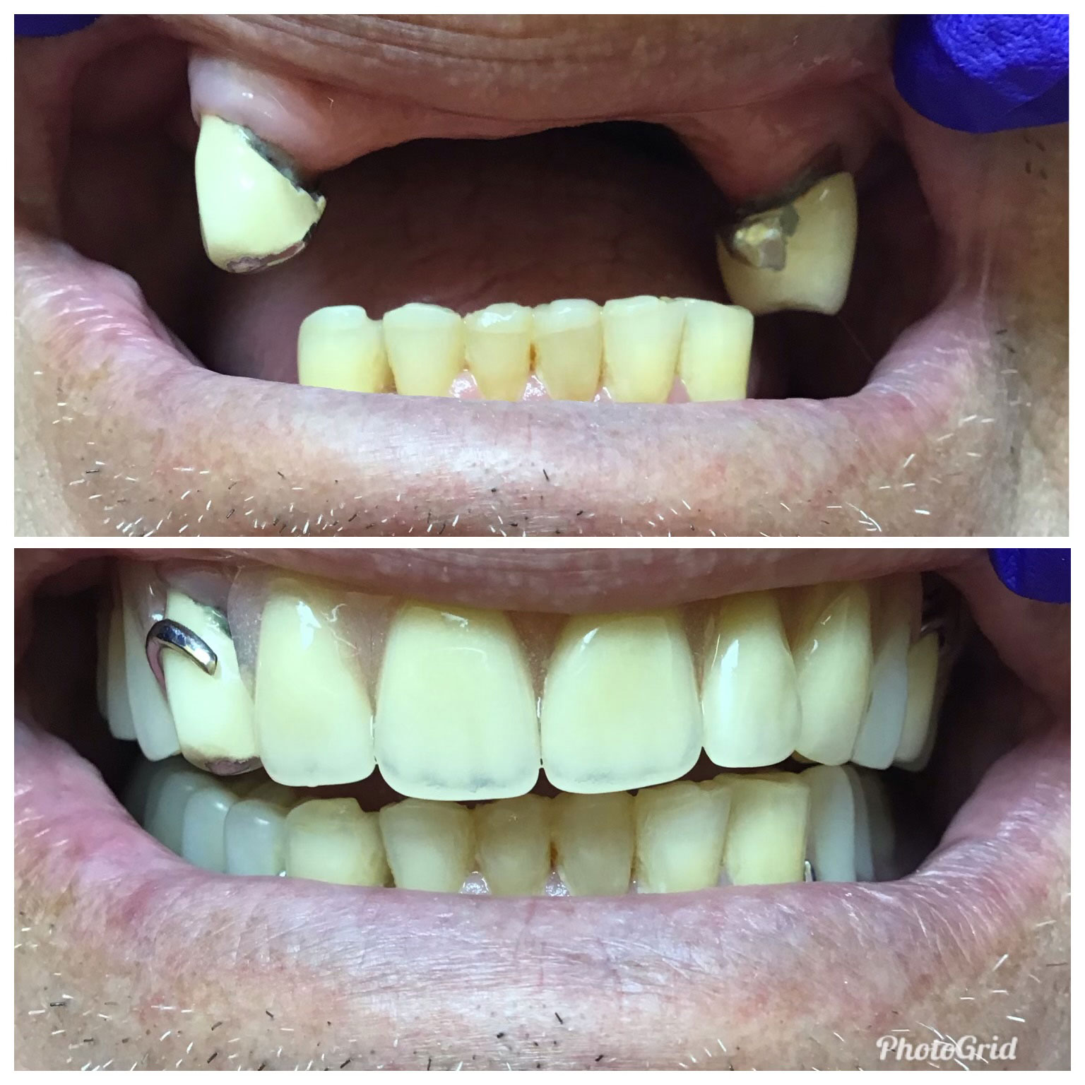 The image shows a person s smile with yellow teeth, some of which are missing, and there is a visible dental implant.