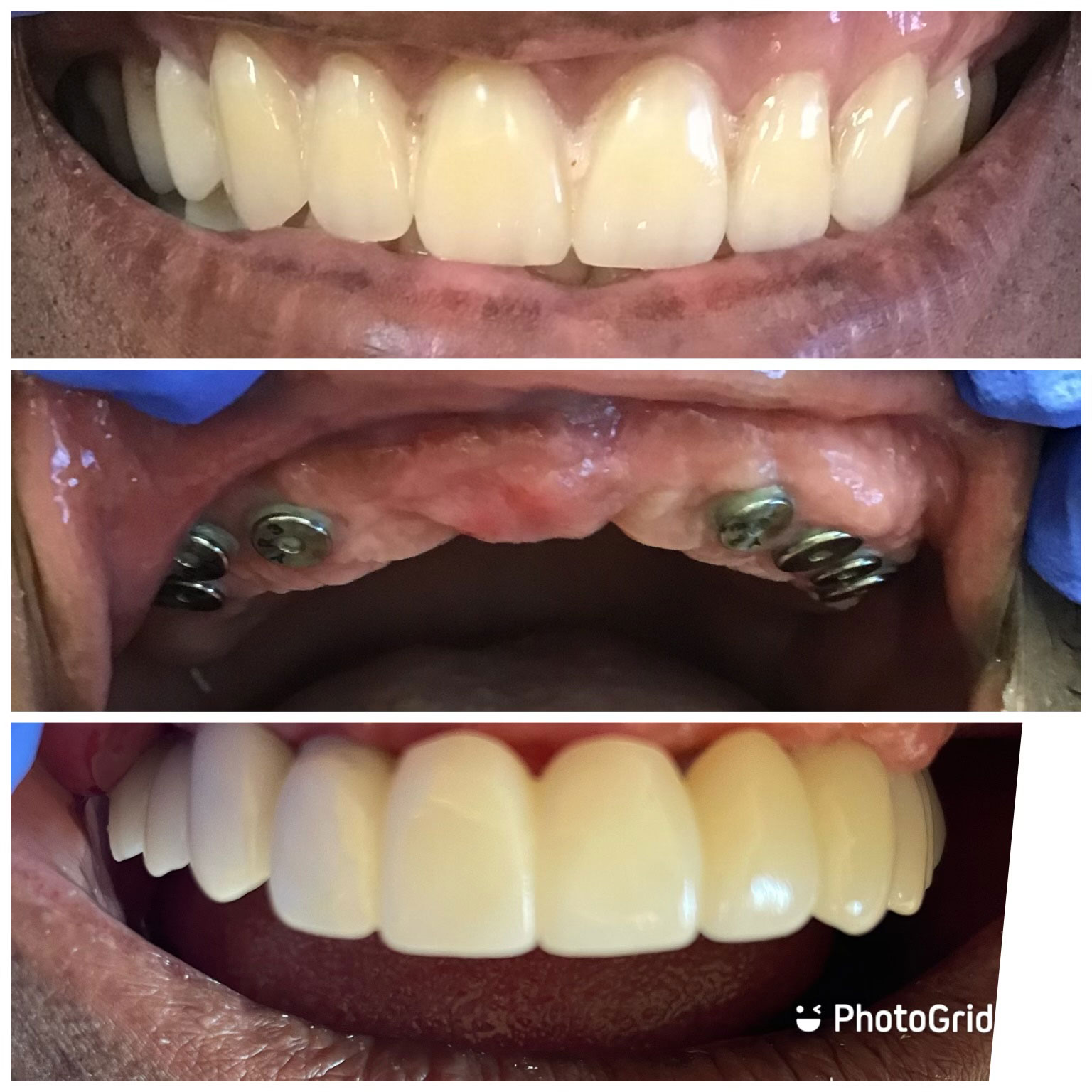 The image is a collage of three photos showing a person with a large smile, displaying their teeth and metal braces.