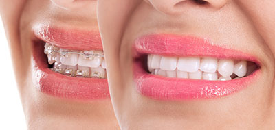 Close-up of a smiling woman with pink lipstick, showcasing her teeth and the cosmetic procedure she has undergone.