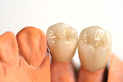 The image shows a set of artificial teeth and gums, likely used for dental implants or prosthetics, with a focus on the natural-looking tooth structure and gum line.