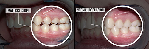 The image shows a side-by-side comparison of two teeth with different levels of decay, labeled as  normal occlusion  and  malocclusion,  highlighting the difference in dental health.