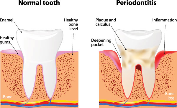 The image displays a three-panel illustration of the stages of tooth decay, labeled from left to right as  normal,   periodontitis,  and  bone loss.  Each panel shows a cross-sectional view of a tooth with a progressively deteriorating structure.