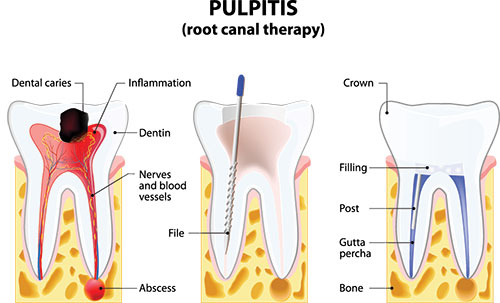 The image is an educational diagram illustrating the process of pulpitis, a dental condition where the tooth s pulp becomes inflamed. It shows a cross-sectional view of a tooth with the affected area highlighted, depicting the progression from inflammation to infection.