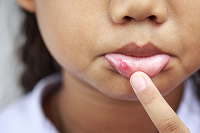 A close-up of a young child s face with a finger pointing to an area on the chin, emphasizing a noticeable skin condition.