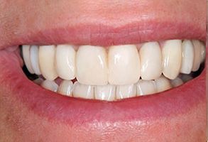 The image shows a close-up of a person s smiling mouth, displaying straight white teeth and gums.