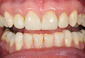 The image shows a close-up of a person s teeth with yellowing, indicating possible discoloration or staining.