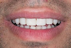 The image shows a close-up of a person s lower face, including a smile with white teeth and pink gums, set against the background of their lips.