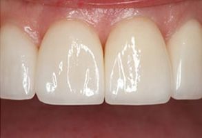 The image displays a close-up of a person's teeth, showcasing a set of white dental implants or veneers with a natural tooth appearance.