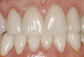 The image shows a close-up of a person's mouth with a focus on their teeth, which appear to be crooked and possibly in need of orthodontic treatment.