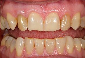The image shows a close-up of a person s teeth with visible signs of decay and discoloration, emphasizing dental health concerns.