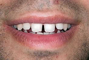 An image of a person s smiling face with a noticeable gap between the upper teeth.